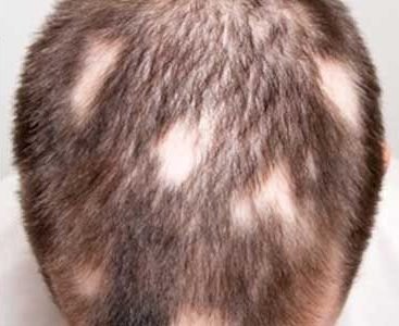 tratamientos para la alopecia