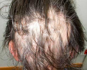 causas de la alopecia