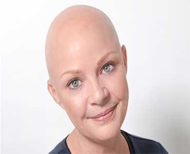Qué tipos de alopecia existen