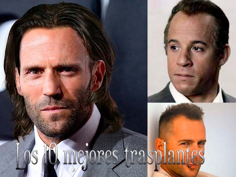 los 10 mejores trasplantes de cabello de las celebridades