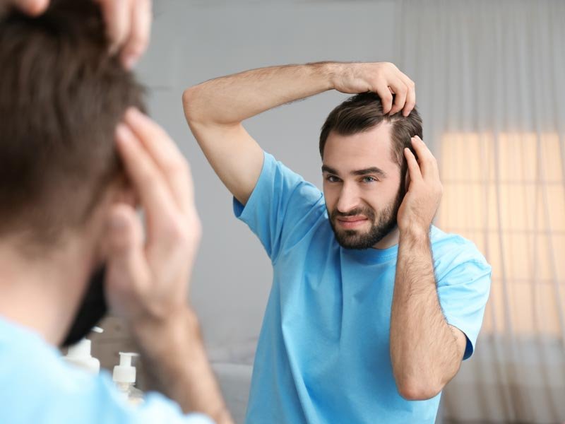 Qué es bueno para la caída del cabello en los hombres
