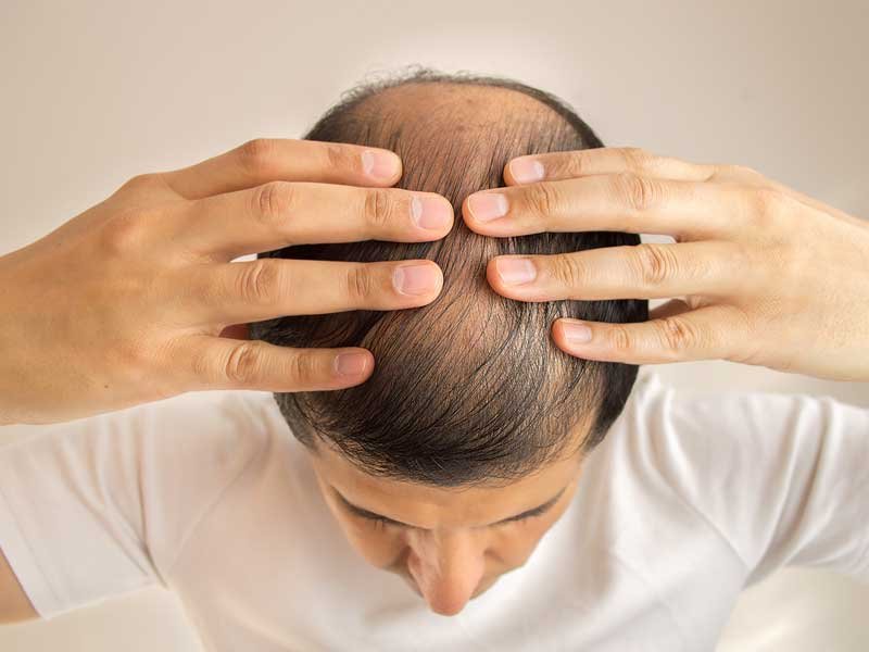 tratamiento de la alopecia areata